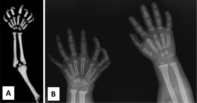 A) TC de miembro superior derecho. Duplicación del cúbito, núcleo de crecimiento epifisario cubital único, ausencia del radio, duplicación de los huesos carpo y metacarpiano. (B) Radiografía comparativa, mano derecha en espejo, mano izquierda normal.